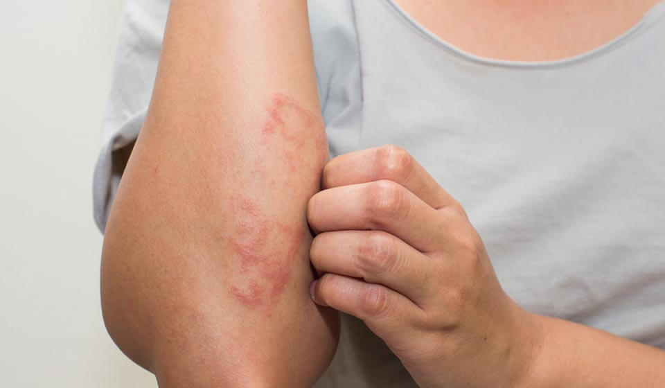 Psicodermatoses, problemas emocionais desencadeados na pele - casule